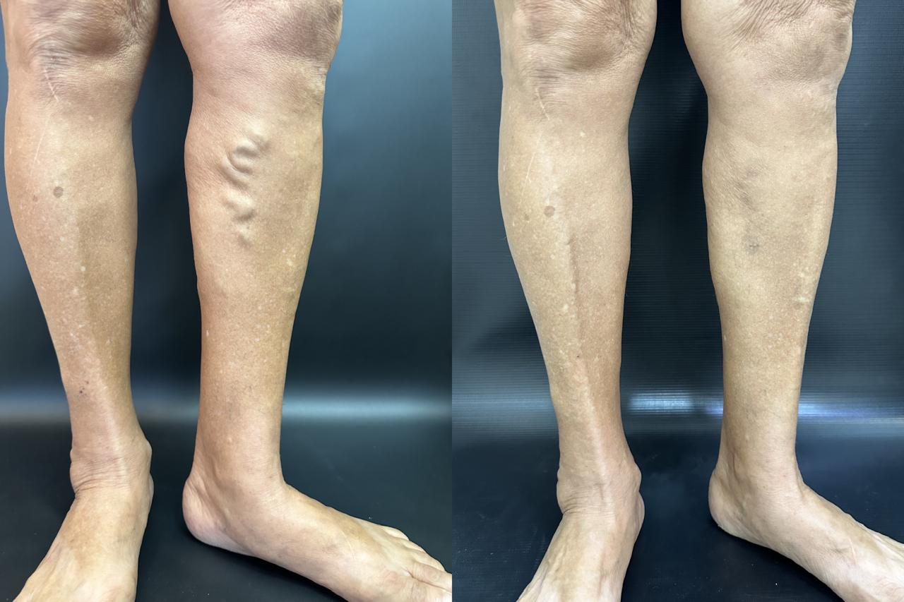 Resultado tratamento de varizes 3