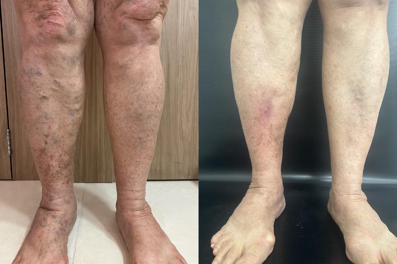 Resultado tratamento de varizes 4